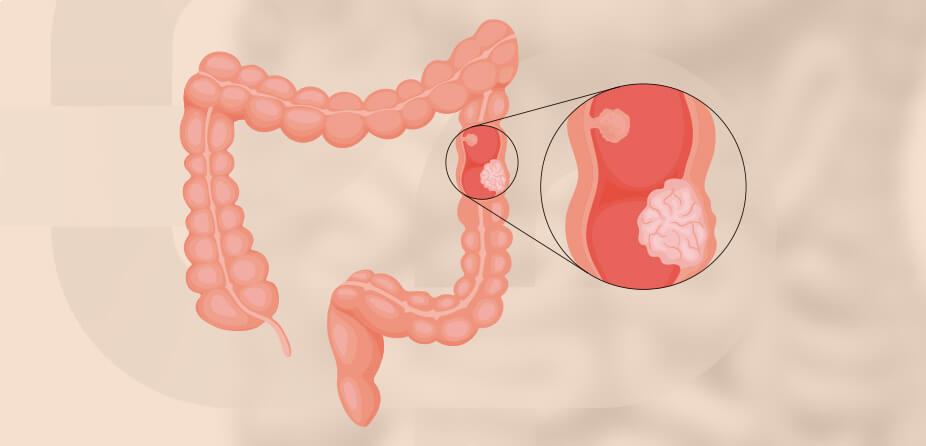 Imagem Câncer colorretal