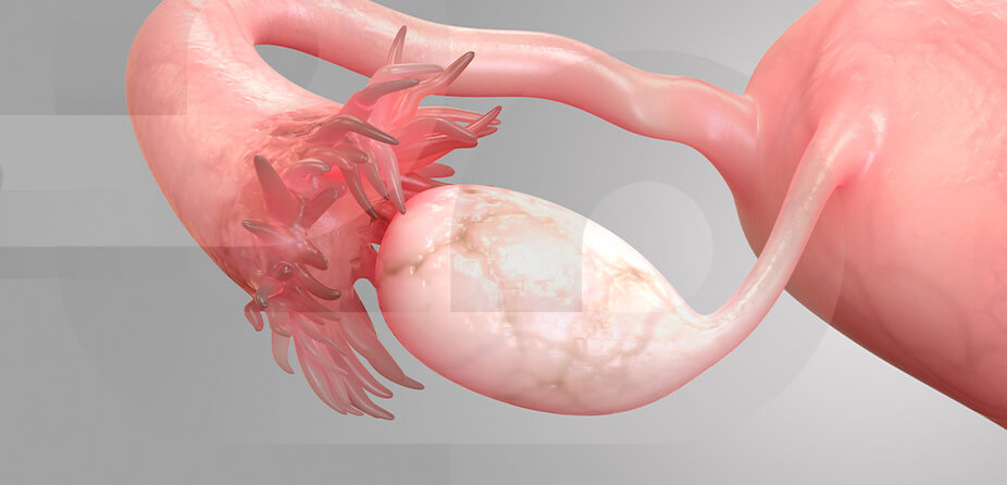 Imagem Câncer de ovário