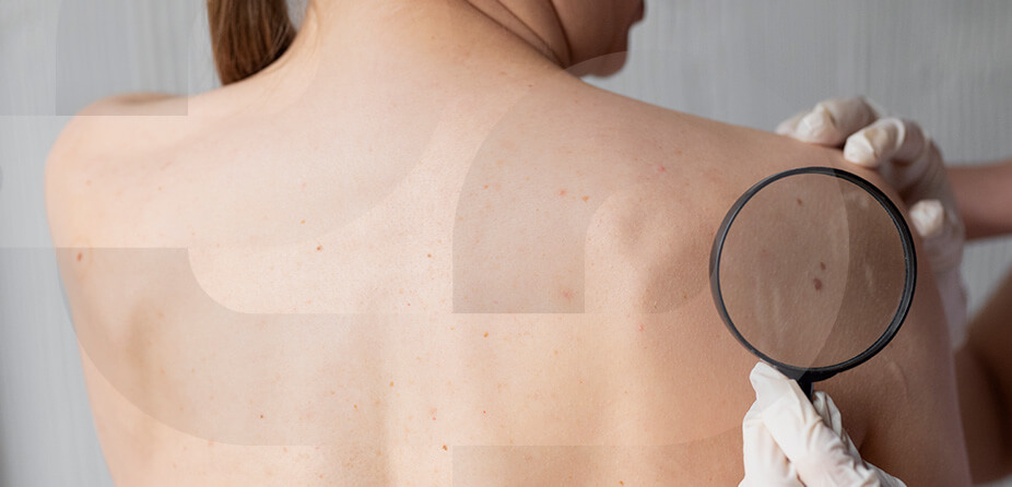 Imagem Câncer de pele